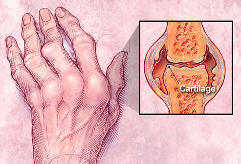 rf illustration of joint with rheumatoid arthritis